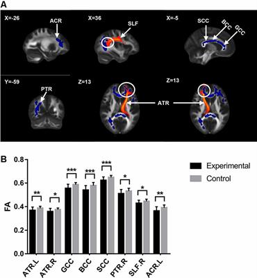 Changes in Empathy in Patients With Chronic Low Back Pain: A Structural–Functional Magnetic Resonance Imaging Study